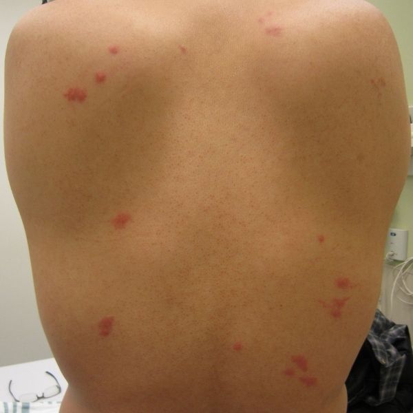 bed bug bites